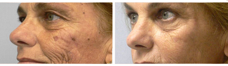 ClearLift: Q-Switched Pixel Laser Treatment results
