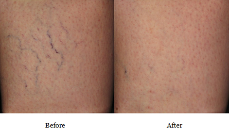 Sclerotherapy before and after photos