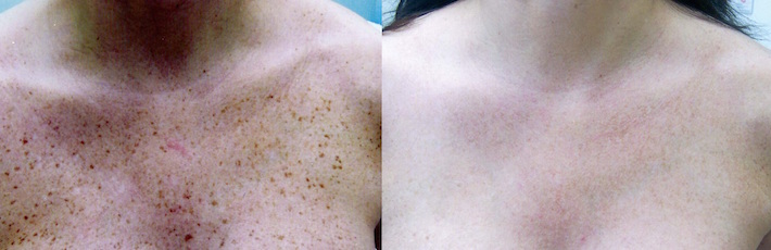 TCA Body Chemical Peel
