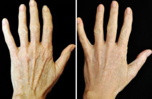 Veins in hand after dermal filler treatment