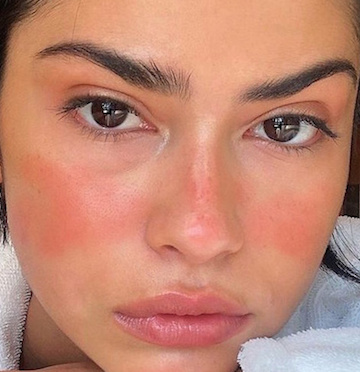 Rosacea Part 1: TYPES